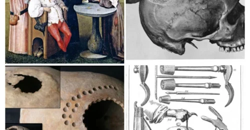 ANCIENT HORROR UNLEASHED: The Shocking Truth Behind Trepanation – Humanity’s Oldest & Most Brutal Brain Surgery Revealed!