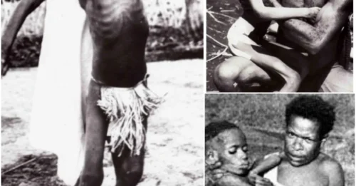 HORRIFYING TRUTH: The Deadly Brain Disease Linked to Cannibalism That Shocked the Medical World!