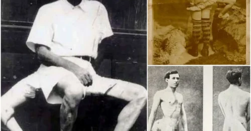 The Bizarre and Tragic Life of Frank Lentini – The Haunting Tale of Frank Lentini, the Man with Three Legs, 16 Fingers, and Two Penises.