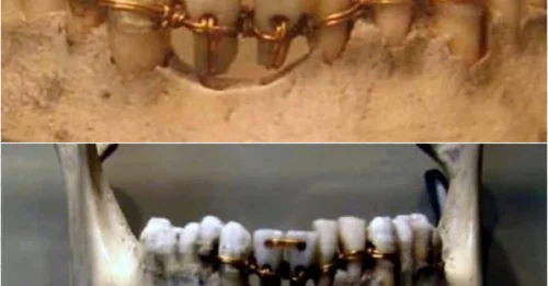 Unearthing Smiles: From Ancient Catgut to Hidden Braces — A 2,000-Year Archaeological Journey Through Orthodontic History