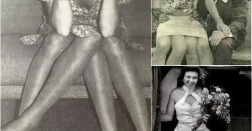 Horrified by Shocking Discovery: The Four-Legged Woman with Two Pelvises – The Dark Secret Behind the 'Medical Marvel' No One Dares to Confront!