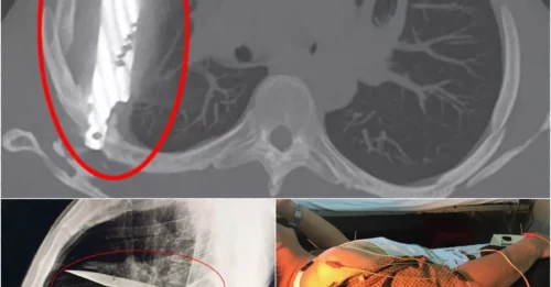 Unbelievable Survival: Man Had a Knife Lodged in His Chest for 8 Years Without Knowing!