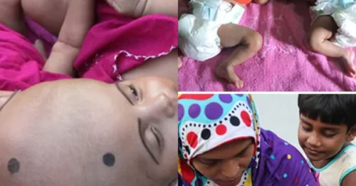 HEARTBREAKING DRAMA: Mother cradles her conjoined twins, endures 730 tear-filled days of waiting with a shocking truth buried by doctors