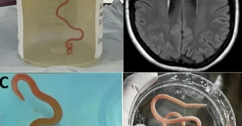Nature’s Nightmare: The First Recorded Case of a PYTHON WORM Infecting a Human Brain Leaves Doctors Stunned