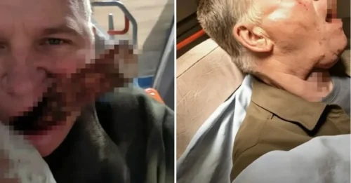 El cuello de un hombre queda atravesado por una PALA tras resbalarse mientras limpiaba nieve, dejando el mango fuera de su boca... pero sobrevive.