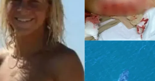 SHARK HORROR SURVIVAL: Teen Releases Graphic Photo of Deep Leg Wounds After Great White Mauling — Then Makes Stunning Return-to-Water Vow